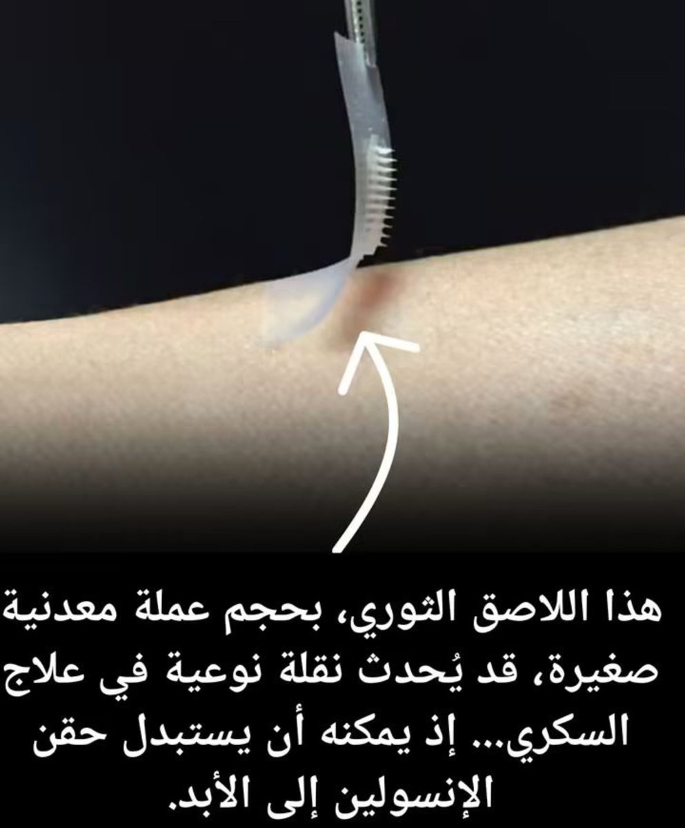 BanafaSh's tweet photo. 🚨 لاصقة الأنسولين: الحقائق في دقيقة! 💉✨
​💡 كيف تعمل؟
إبر ميكروسكوبية بلا ألم، تفرز الأنسولين تلقائياً عند ارتفاع السكر وتتوقف عند انضباطه!
​🏥 لمن تنفع؟
• النوع 1: بديل مريح للشكشكة.
• النوع 2: لمن يحتاج أنسولين قاعدي.
​شاركها لتنشر الأمل! 🔄💙
​#لاصقة_الأنسولين #السكري https://t.co/gojt8YvpNS