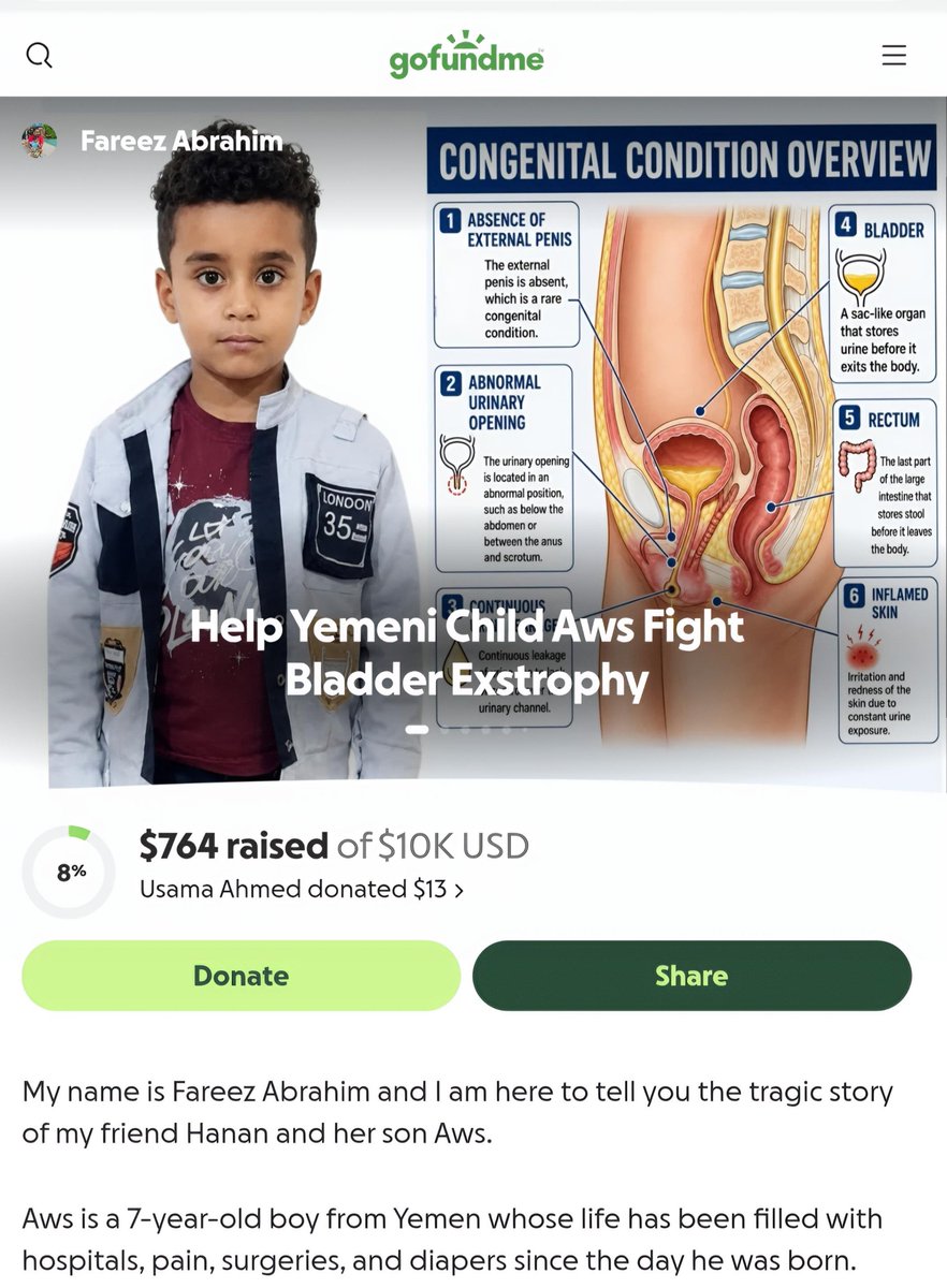 BilqisYeme6i's tweet photo. 💔 Aws needs you!
A 7-year-old Yemeni boy suffering from a rare congenital deformity and in need of multiple surgeries
After 99 days, only $764 has been raised
Please donateeven just $5 or share the campaign
Your share could reach someone who can save Aws.
https://t.co/I5evJmbLif https://t.co/ALVnQRyuE0