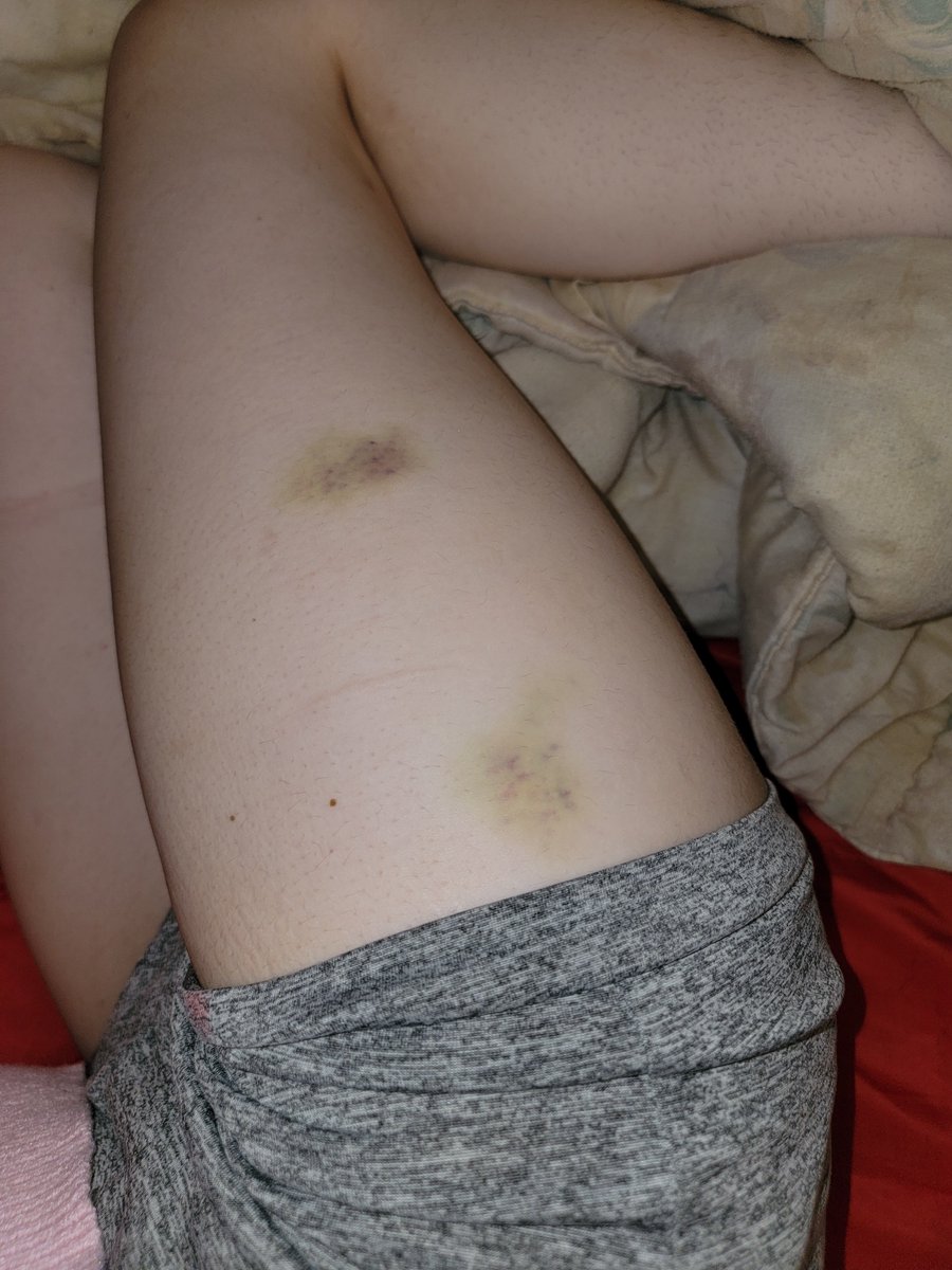 Darlingwolve's tweet photo. Its getting worse https://t.co/BQEknV1xLT