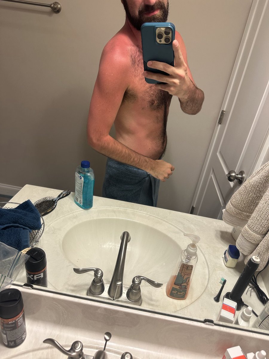 jtXXX_69's tweet photo. Just a little sunburnt 🤣 https://t.co/O0hfbnFZi1