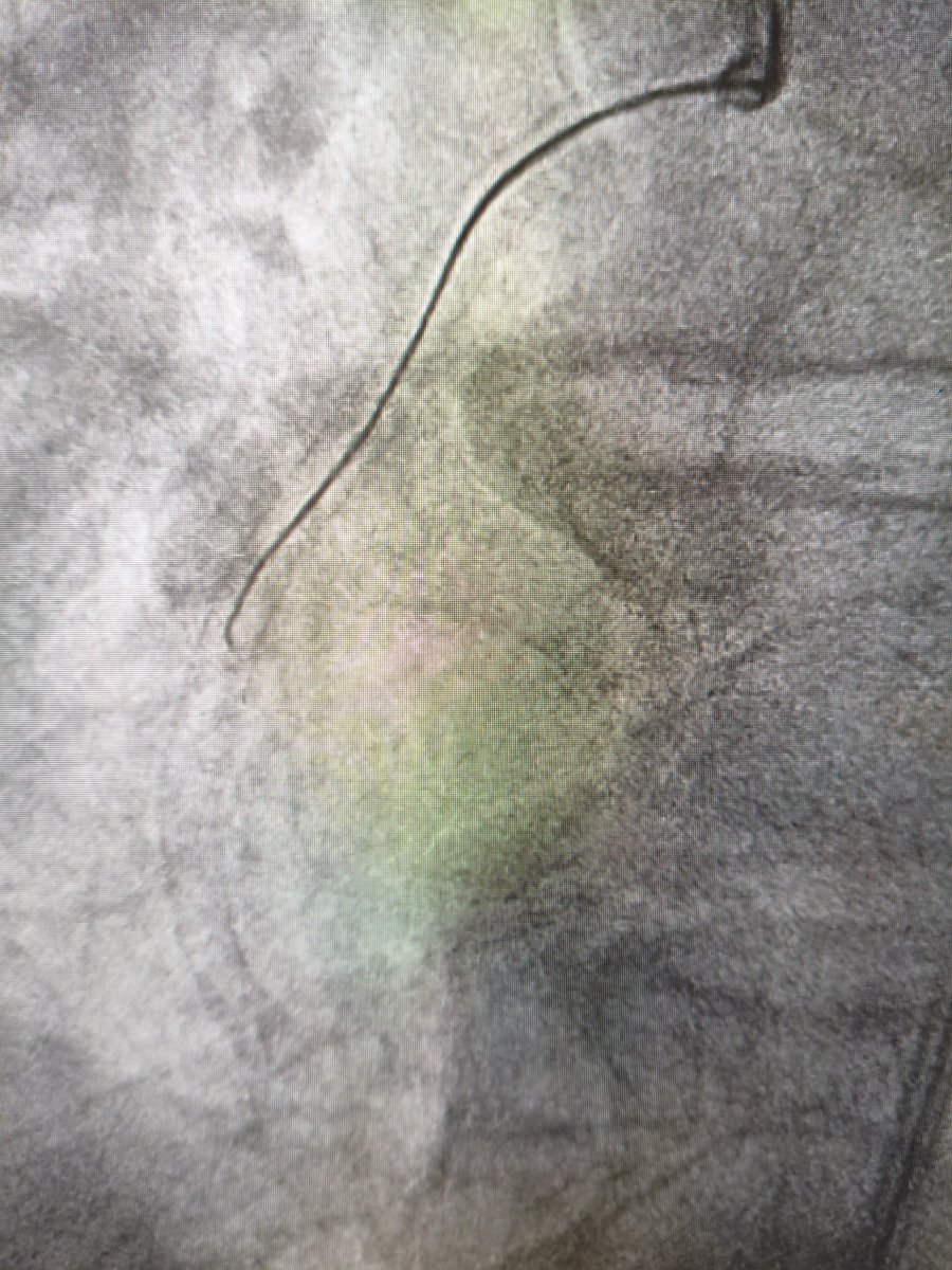 MarekRadomski71's tweet photo. #IVUS #CTO #PCI next "don't skip IVUS" even when angio looks quite good. Approx. 23 yo in stent restenosis CTO body crossed with Gaia2nd and Corsair Pro ( strong support 8F GC + 8F GE). Bi directional wire path control and surprise: in IVUS few mm outside old stent. https://t.co/dFejxlMumX