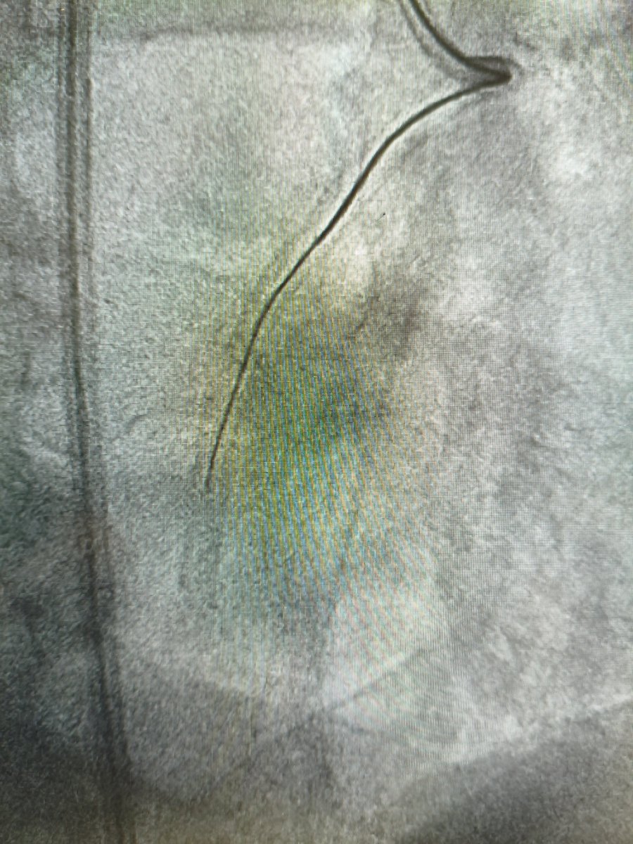 MarekRadomski71's tweet photo. #IVUS #CTO #PCI next "don't skip IVUS" even when angio looks quite good. Approx. 23 yo in stent restenosis CTO body crossed with Gaia2nd and Corsair Pro ( strong support 8F GC + 8F GE). Bi directional wire path control and surprise: in IVUS few mm outside old stent. https://t.co/dFejxlMumX