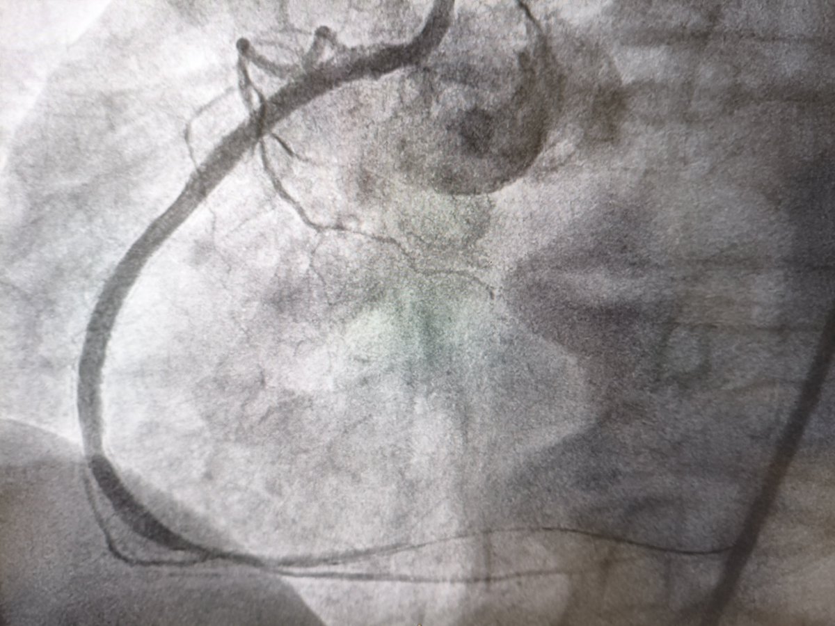 MarekRadomski71's tweet photo. #IVUS #CTO #PCI next "don't skip IVUS" even when angio looks quite good. Approx. 23 yo in stent restenosis CTO body crossed with Gaia2nd and Corsair Pro ( strong support 8F GC + 8F GE). Bi directional wire path control and surprise: in IVUS few mm outside old stent. https://t.co/dFejxlMumX