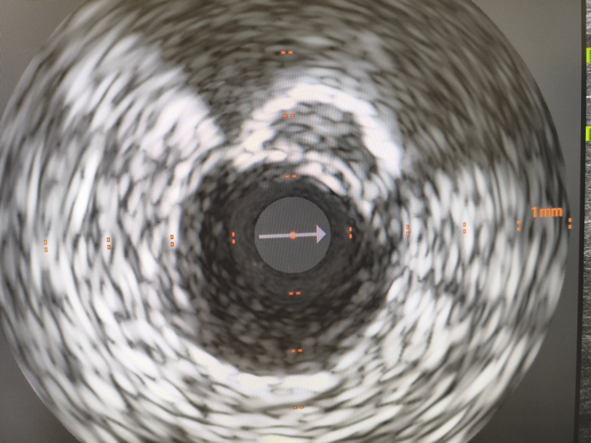 MarekRadomski71's tweet photo. #IVUS #CTO #PCI next "don't skip IVUS" even when angio looks quite good. Approx. 23 yo in stent restenosis CTO body crossed with Gaia2nd and Corsair Pro ( strong support 8F GC + 8F GE). Bi directional wire path control and surprise: in IVUS few mm outside old stent. https://t.co/dFejxlMumX