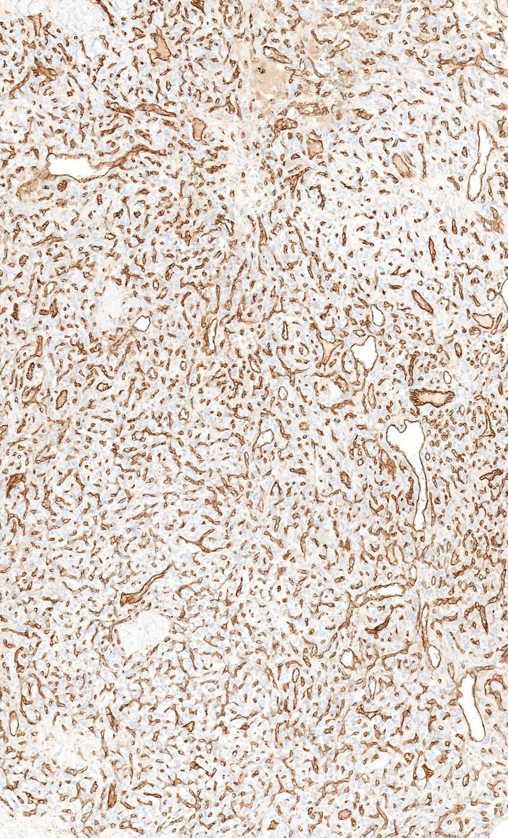 JMGardnerMD's tweet photo. Adult neck mass. CD31 immunostain shown. What other stains would you order? 
Answer ✅ https://t.co/QCMj6U3Vun 
More Stains: https://t.co/QRmoO5yDeX
H&amp;E 🔬 https://t.co/cbywzmgvHY 
#BSTpath #pathologists #pathology #pathTwitter #ENTpath https://t.co/ABvPSlJexW