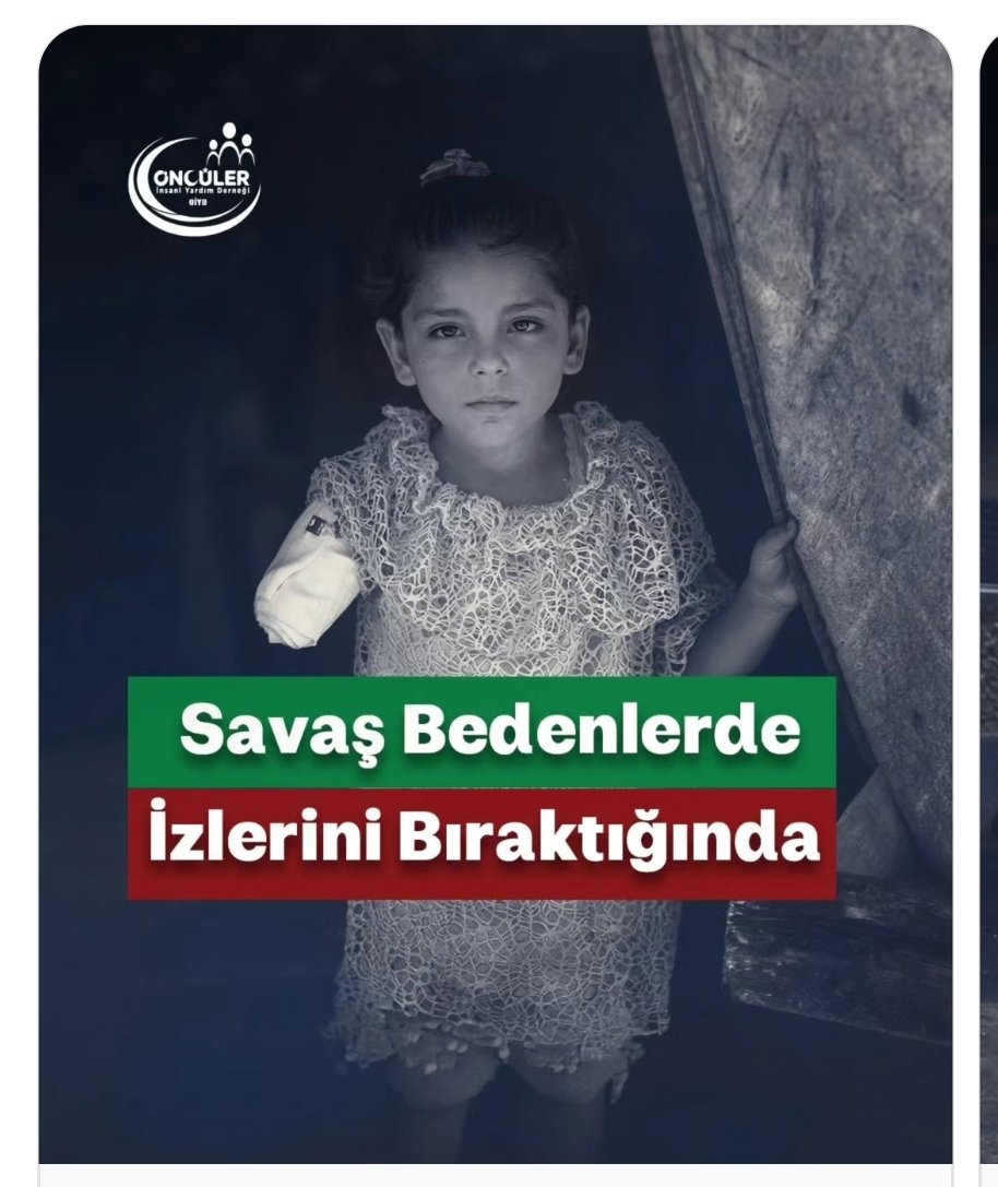 Ferdi_Karabasan's tweet photo. Gazze’de binlerce insan, uzuv kaybı ve kalıcı engellerle savaşın ağır sonuçlarını bedenlerinde taşıyor. 

Savaş bittiğinde bile, bazı izler ömür boyu kalacak. https://t.co/ko0tTUkqSo