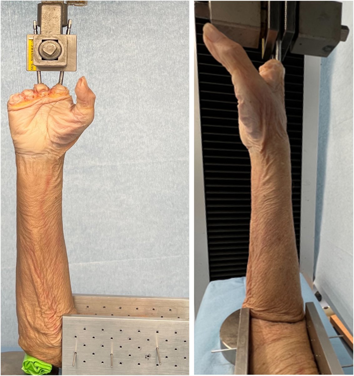 JHandSurg's tweet photo. This JHS cadaver study shows ulnar variance rises linearly with axial load (1.7mm to 3.0mm at 300N), with the ulna and lunate shifting closer together, demonstrating dynamic ulnar impaction. https://t.co/cwbyF8AE41
#JHS #handsurgery #wrist https://t.co/zvo2u7nM2z