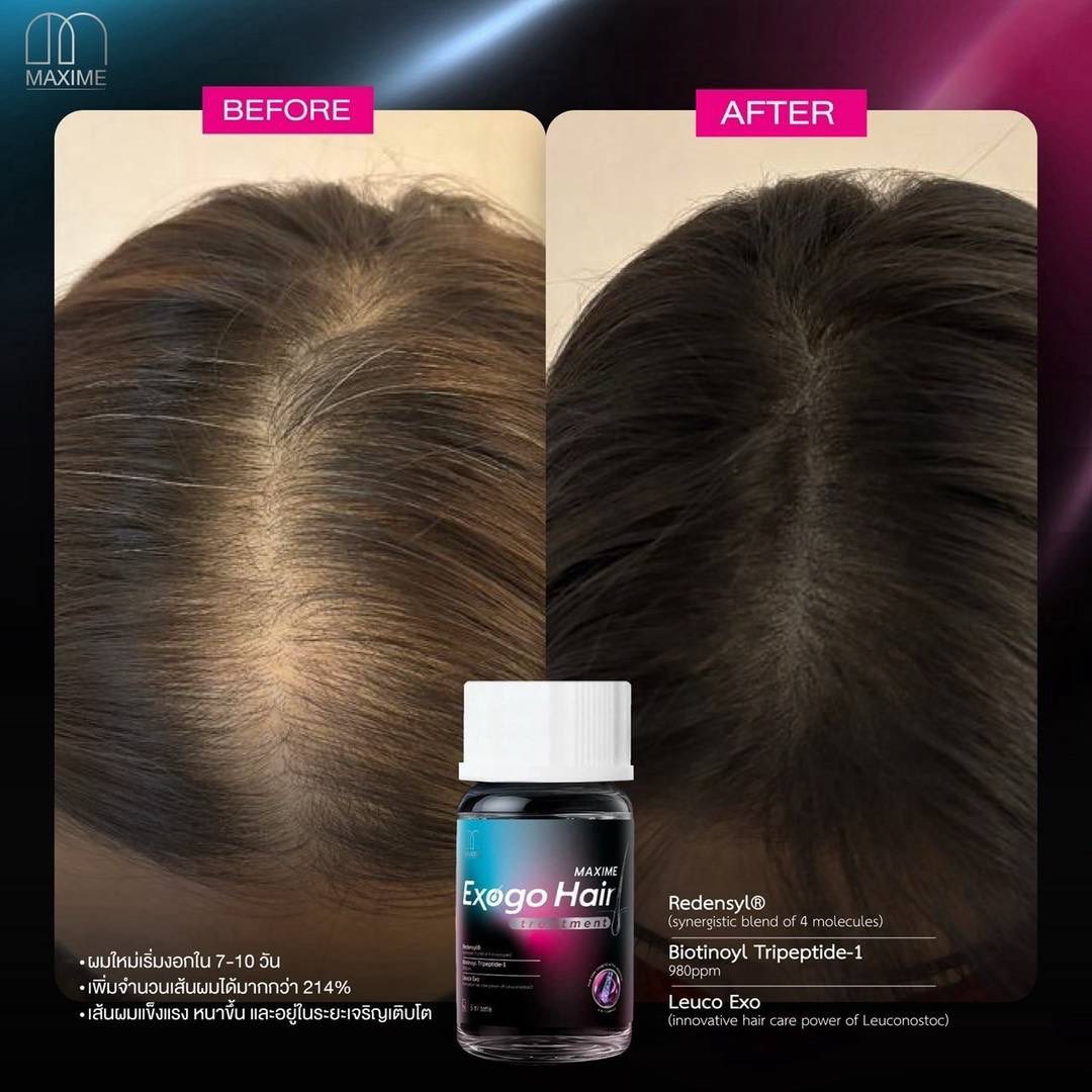 aleksomb's tweet photo. EXOGO HAIR by MAXIME 🧬✨
Premium Hair &amp; Scalp Care สำหรับการดูแลเส้นผมและหนังศีรษะอย่างลึกซึ้ง
ออกแบบมาเพื่อการดูแลสมดุลของหนังศีรษะ
ช่วยให้เส้นผมดูแข็งแรง มีน้ำหนัก และดูสุขภาพดีขึ้นเมื่อใช้อย่างต่อเนื่อง 💛
🔬 จุดเด่นของการดูแล
• https://t.co/CmMAeqsrXe
