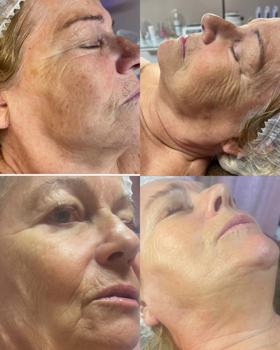 HKatarine's tweet photo. La Radiofréquence Biyona Microskin est efficace pour les soin du visage et du corps
- relâchement cutanés
-rides
-pores dilatés
-vergetures
-destockage des adipocytes (minceur )âchesbrune https://t.co/A0sShzzOXG