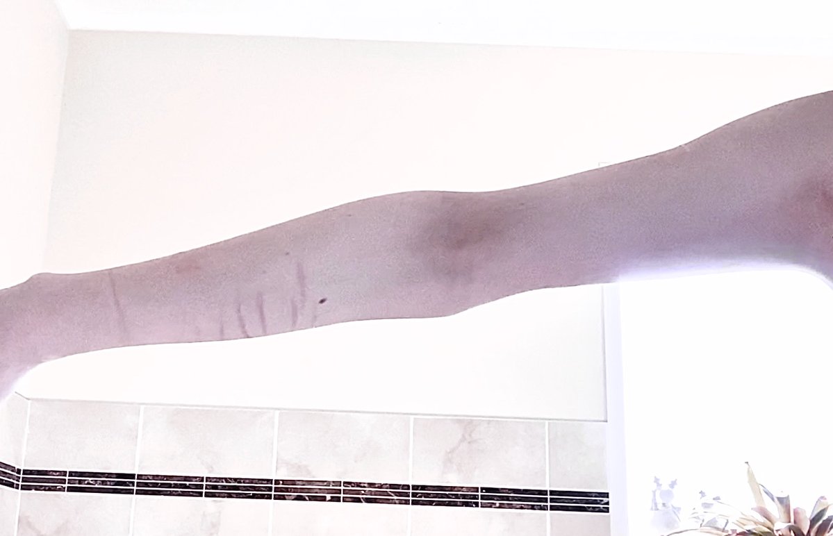 Fawn_C0ff33's tweet photo. Skinny arms but the rest of me is fat, I’m cursed #edtwt https://t.co/QHI75j0ENO