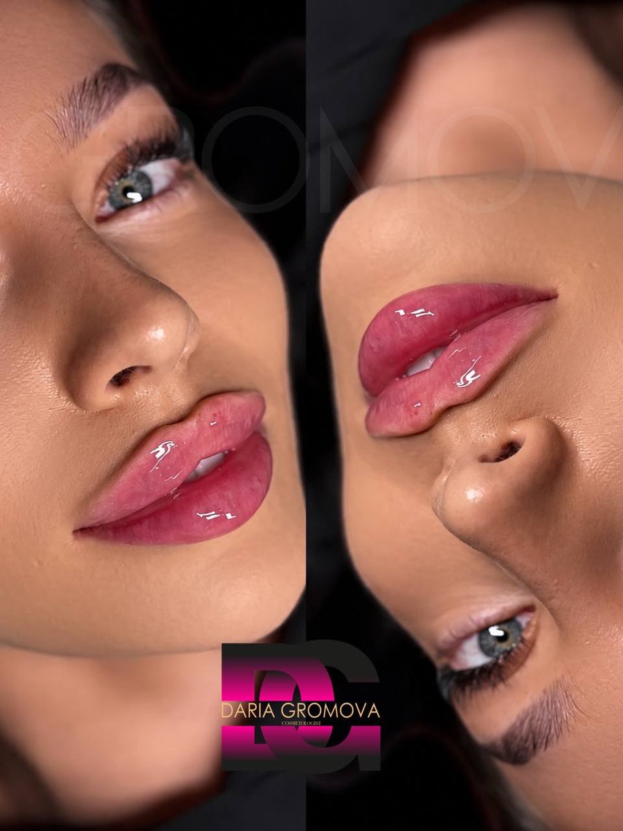 TequilaByan's tweet photo. 3500 MXN 💋 🇲🇽Cancúnt
Agosto
1, 2, 8, 9, 10
-💉Rostro completo: 10 500
MXN
5 ml de relleno + labios +
Botox💉🫦 

(💉🫦Solo labios – 3. 500 MXN)💉🫦

🇲🇽Cancún
August
1, 2, 8, 9, 10
-💉Full face: 10, 500 MXN
5 ml of filler + lips +
Botox💉🫦 https://t.co/R2myvso8Es