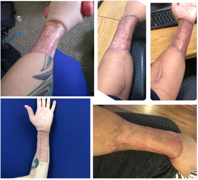 Puflito___'s tweet photo. Así le queda el brazo a las mujeres transgénero después de someterse a una faloplastia, procedimiento que consiste en removerles la mayor parte de la piel y el músculo de su brazo para fabricarles un pene falso y disfuncional

Esto las deja con un brazo débil, con poca movilidad, con poca sensibilidad y en algunos casos con dolor crónico para toda la vida

Amen a sus hijas y cuídenlas de todos los seres perversos que quieren convencerlas de que esto es un procedimiento normal