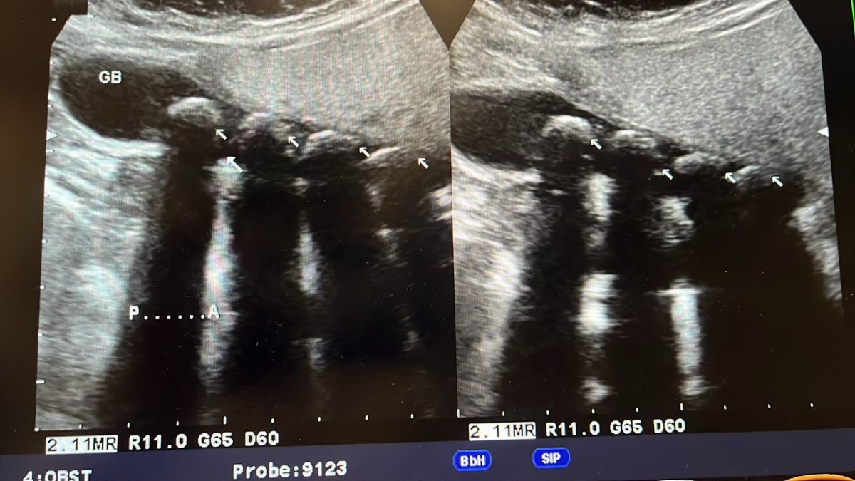 RadiographyNG's tweet photo. Middle aged female patient. Complaint of intermittent Epigastric pains. https://t.co/vcvyL7XGMp