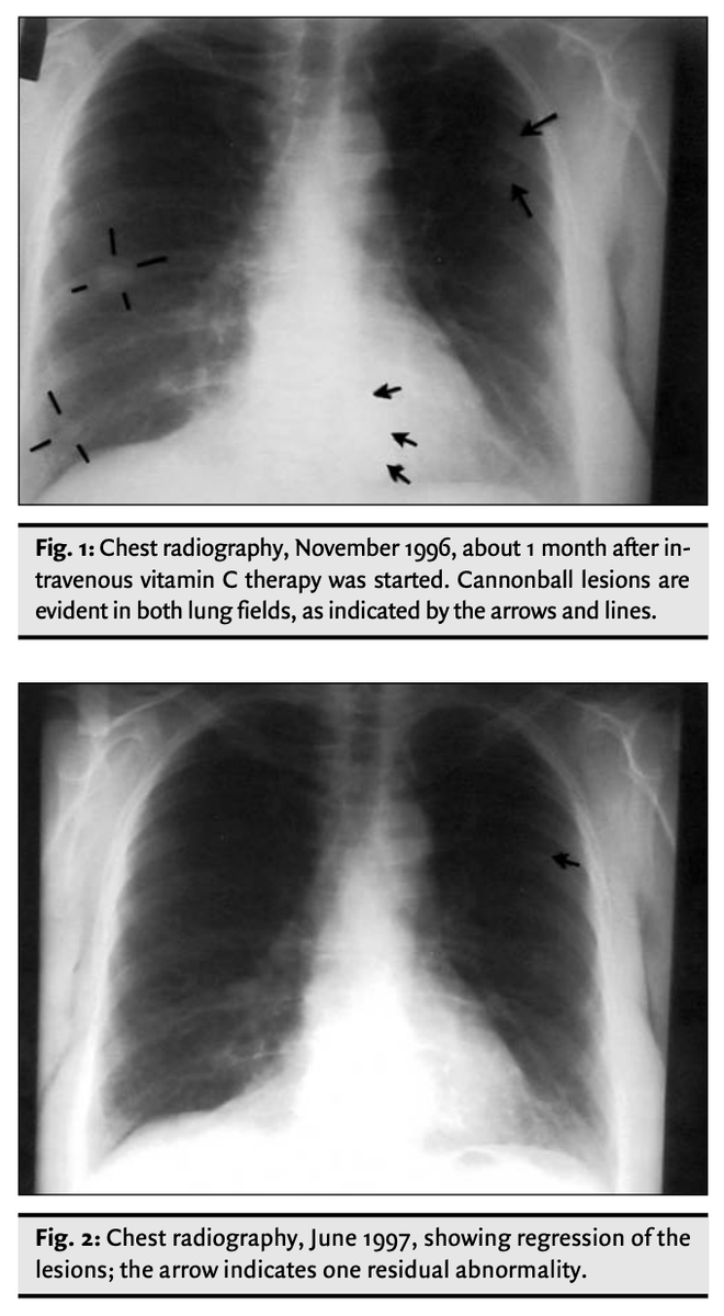 Outdoctrination's tweet photo. Tumors vanished with vitamin C megadoses.

She rejected conventional cancer treatment and opted for IV vitamin C, 65 g 2x a week.

Also took NAC, niacinamide and natural desiccated thyroid.

10 months later:

"chest radiography results were normal except for one remaining abnormality in the left lung field, possibly a pulmonary scar"

This is one of many cases on vitamin C and cancer. More covered in the thread below.