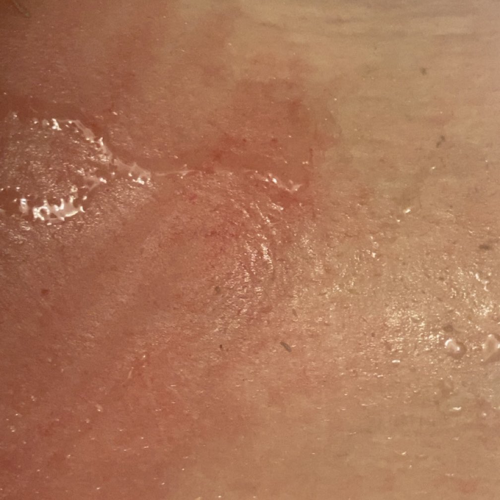 neonsaddict's tweet photo. First time self harming in almost 2 years
Im actually kinda Cryinf r
I don’t know why I started scratching but then I couldn’t stpp and honestly I don’t want to but then guilt rn is weighing on me https://t.co/BiibzTwuOJ