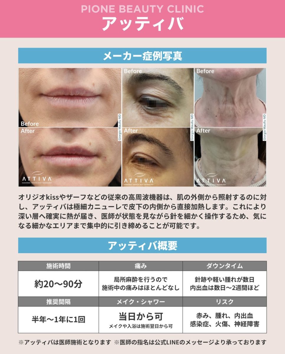 ピオーネでメンテついでに気になってたアッティバやって2週間くらい経ったんだけど
明らかに人中の間延び感と厚み？モーンとした感じが薄れて撮影盛れるようになった！笑

眉下やるか迷ってた瞼にもやったけど
二重幅ちょっと広くなったから画期的すぎて感動して久々にX投稿しにきた笑

ダウンタイムは2枚目みたいにメイクで隠せる程度の内出血と当日少し腫れるだけ

ソフウェーブとアッティバはメンテで続けよ˙˚ʚ(꒪ˊ꒳ˋ꒪)ɞ˚˙