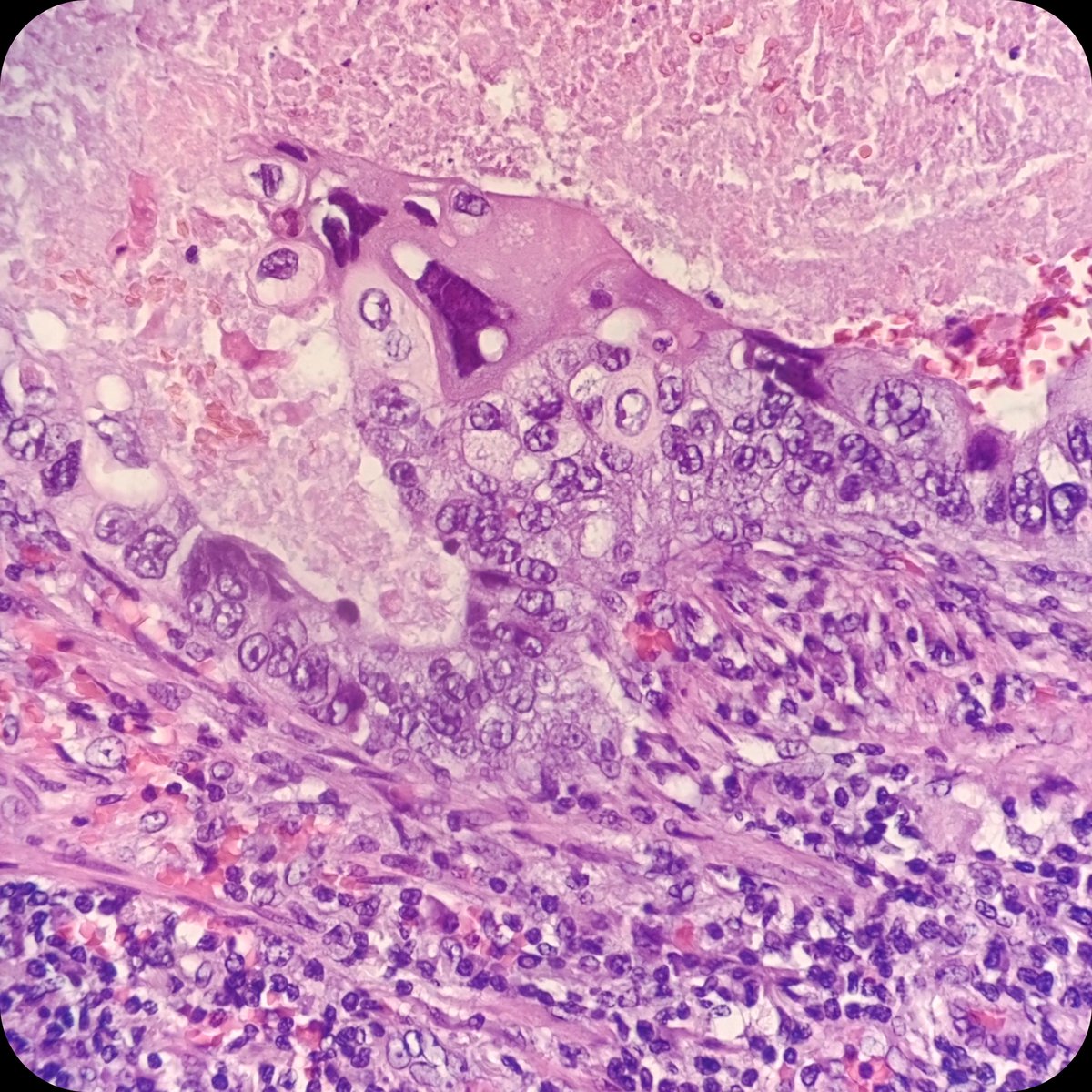 duckhuca's tweet photo. 🫁 Lobectomy.
🔬 Lung Adenocarcinoma.
🔥 Inflamed tumor.

#LungCancer #LungPath https://t.co/AaHpIXrFtf