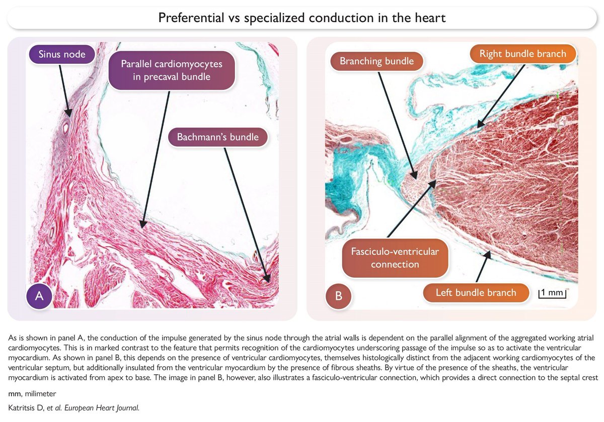 HaseebEPHF's tweet photo. ✍️2026 ESC State of art Review__
"Preferential conduction in the Atria: Clinical Implications"
https://t.co/GRflquJmQv https://t.co/EsdO8o8ScS