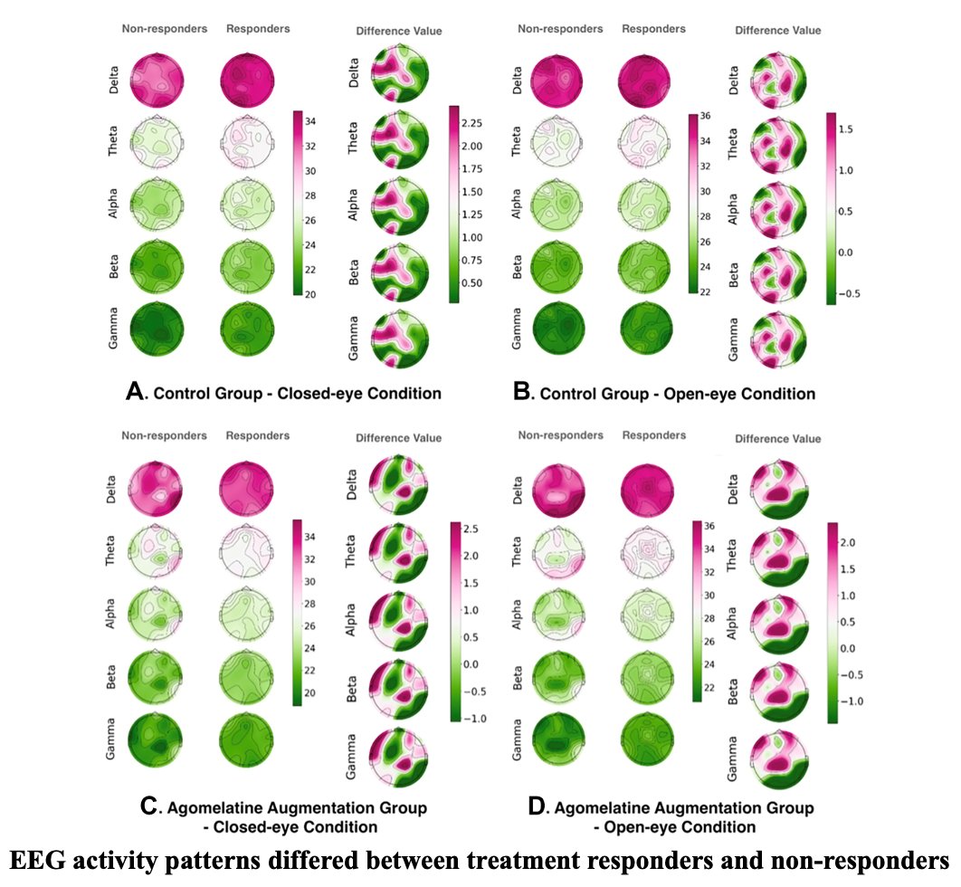 GPsych_Office's tweet photo. Can #agomelatine help with low motivation and social withdrawal in #schizophrenia? In a randomized trial of 74 patients, adding it to second-generation #antipsychotics led to greater symptom improvement from week 8. EEG patterns also showed promise for predicting response.👇
@GPsych_Office  
@WileyBrainPsych 
https://t.co/UWZBHr89Sl