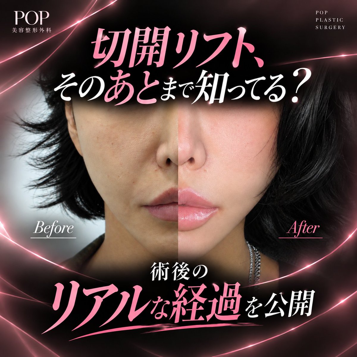 POPJapanPS's tweet photo. 切開リフトのリアルな経過、公開します౨ৎ⋆˚

気になるたるみ・ほうれい線・
フェイスラインをすっきり。

手術直後→1週間→1ヶ月の
ダウンタイム・経過から、
気になる傷跡までチェック🔍˖ ࣪

耳のラインに沿って切開し、傷跡にも配慮します。

💌写真カウンセリング
LINE @139jiocx

※一部画像にAI生成イメージを使用しています。