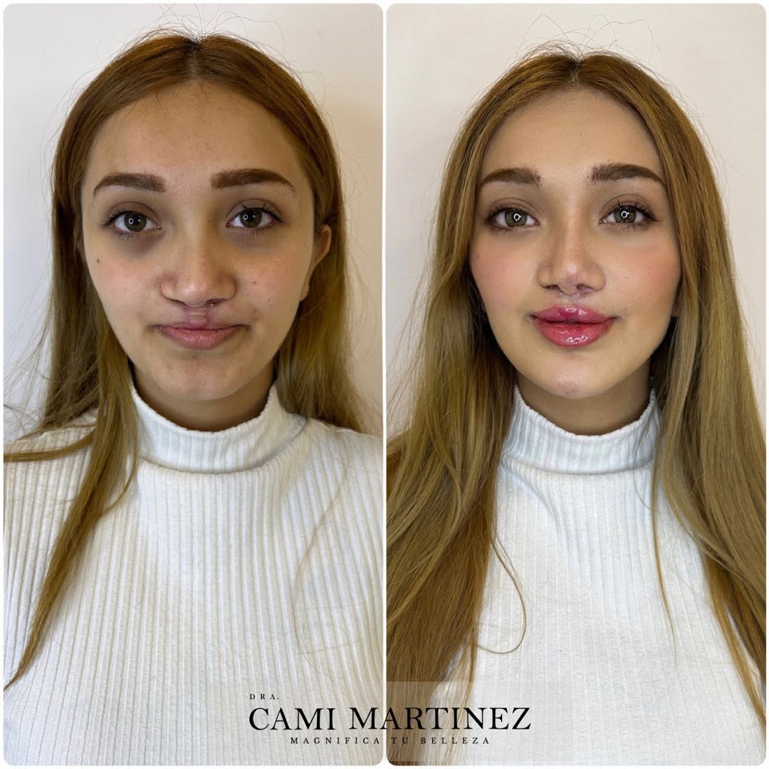 marthamor1hs's tweet photo. Un vistazo a cambios que valen la pena recordar este . ¿Tienes un favorito?
El procedimiento fue un full face utilizando toxina botulínica y fillers.
Escríbenos por DM o WhatsApp mediante el enlace en nuestra biografía. 🔝

En cada sesión aplicamos el... https://t.co/oeSJot4kbu