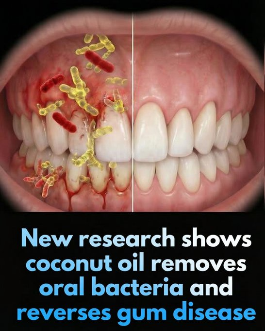 Rainmaker1973's tweet photo. Coconut oil pulling offers a simple, natural way to support better oral hygiene, potentially as easy as using a spoonful of the oil in your mouth.

Recent research highlights its role as a scientifically supported antimicrobial practice that can help reduce harmful oral bacteria, plaque accumulation, and early signs of gum inflammation (gingivitis).

The key active component is lauric acid, which comprises about 45–50% of virgin coconut oil. When swished around the mouth, the oil mixes with saliva, undergoing saponification (a soap-like reaction) that helps mechanically dislodge debris and exert antibacterial effects. Studies show this process can significantly lower counts of Streptococcus mutans, the main bacterium responsible for tooth decay and plaque, while also decreasing plaque scores, gingival inflammation, and bleeding in cases of plaque-induced gingivitis.

For best results, take 1 tablespoon of virgin (unrefined) coconut oil, swish it gently for 15–20 minutes on an empty stomach (ideally in the morning), then spit it into the trash (not the sink, to prevent pipe clogs). Follow with your regular brushing and flossing routine.

While evidence from systematic reviews and randomized trials (including meta-analyses up to 2024–2025) supports moderate benefits for reducing plaque, gingival indices, and bacterial loads, often comparable to chlorhexidine mouthwash in short-term use, oil pulling is not a cure-all. It does not reverse advanced gum disease (periodontitis), regenerate lost gum tissue or bone, or replace professional dental care, scaling, root planing, or prescribed treatments. It works best as a complementary adjunct to standard oral hygiene practices.

Experts, including those from the American Dental Association and recent reviews, note that while promising, more high-quality, large-scale studies are needed for definitive long-term conclusions. Always consult your dentist before adding new routines, especially if you have existing oral health issues.

[Jong FJX, et al. (2024). The effect of oil pulling in comparison with chlorhexidine and other mouthwash interventions in promoting oral health: A systematic review and meta-analysis. International Journal of Dental Hygiene, 22(1):78–94. doi:10.1111/idh.12725]