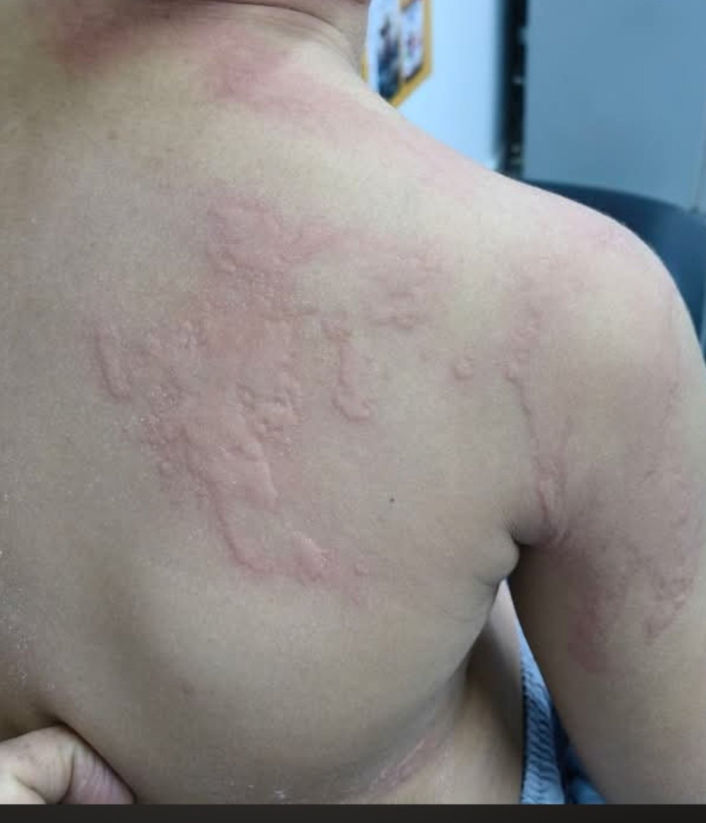 DalulainGaza's tweet photo. These spots appeared on my daughter's body. I don't know if they are contagious or dangerous. 🥺

https://t.co/MfwQOKJDkb https://t.co/RkUx6pBPCS