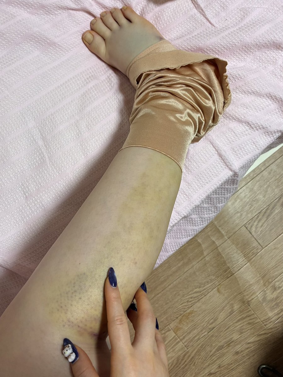 ふくらはぎ脂肪吸引から3日、早くも変化出てきた😮‼️

「ふくらはぎは取れる脂肪が少ないから、ドラマティックな変化は出にくい」って言われてたけど、個人的には既に結構スッキリしてきてる気がする。

まだ腫れてるけど脚のラインが明らかに変わってきて、既にやってよかったと思い始めてる… https://t.co/pDnOjeUYc0
