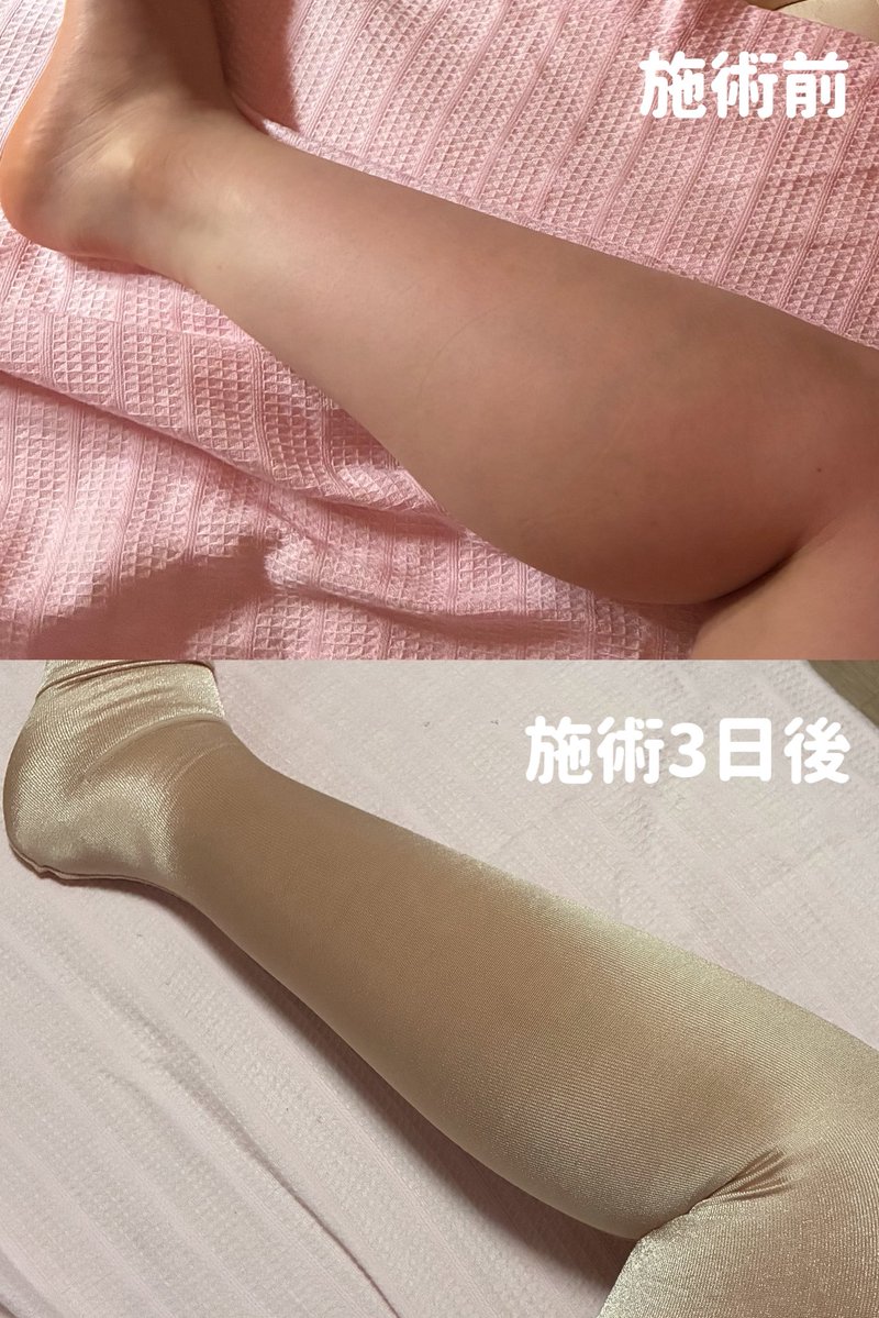 ふくらはぎ脂肪吸引から3日、早くも変化出てきた😮‼️

「ふくらはぎは取れる脂肪が少ないから、ドラマティックな変化は出にくい」って言われてたけど、個人的には既に結構スッキリしてきてる気がする。

まだ腫れてるけど脚のラインが明らかに変わってきて、既にやってよかったと思い始めてる… https://t.co/pDnOjeUYc0