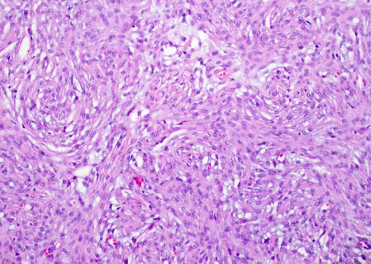 JMGardnerMD's tweet photo. Can you make the diagnosis from one pic, or is it #TooCloseToDiagnose? 
More pics: https://t.co/qtsOT70Ksc 
Answer ✅ https://t.co/3fOaPrkgvz
#pathology #pathologists #pathTwitter #dermpath #dermatology #dermatologia #dermtwitter #BSTpath https://t.co/FcYfaJromy