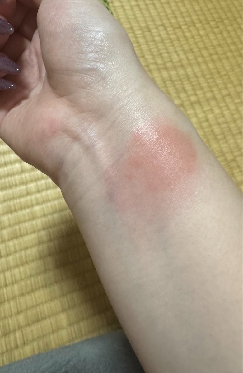 ryoxxpii's tweet photo. ダニかなんかに刺されたところめっちゃ腫れてて薬塗ると広範囲だしベタベタしちゃうから上からガーゼ貼ったらお客さんにリスカ？って言われてしんだ
聞いてきたやつもノンデリだけど何も言わずに勘違いされてるよりは聞いてくれて逆に反論できるから良かったわ😹 https://t.co/i3w07H0Kzm