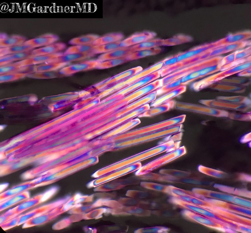 JMGardnerMD's tweet photo. What's this beautiful rainbow? 
Answer ✅ https://t.co/BGLOsVGjYA 
When I see this, I pop in the polarizer filters on my microscope to get appropriate oohs &amp; aahs from new #pathology trainees &amp; #medstudents! 😎 
#meded #pathology #pathTwitter #dermpath #dermtwitter https://t.co/nK1mJuhH9g