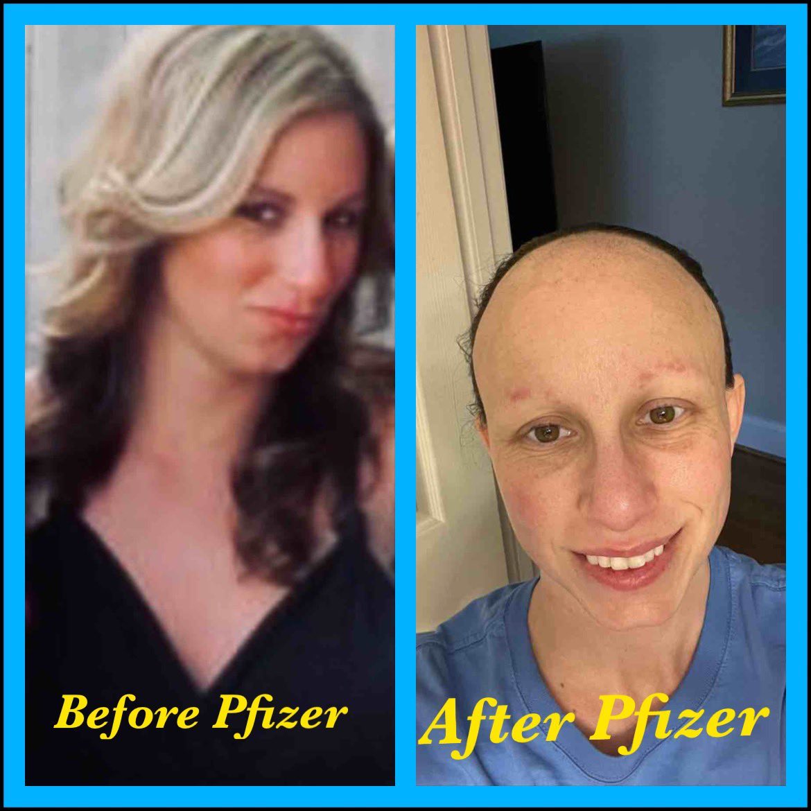 HouseLyndseyRN's tweet photo. 5 months post treatment…

May was my last treatment session in Japan - (2 dfpa and 10 sgf infusions in april, 1 dfpa and 5 sgf infusions in May)

I am currently still at 80-85% functional & I am able to complete my Activities Of Daily living without Assistance

my hair, skin & nails are steadily growing daily

JUST KEEP SWIMMING :)