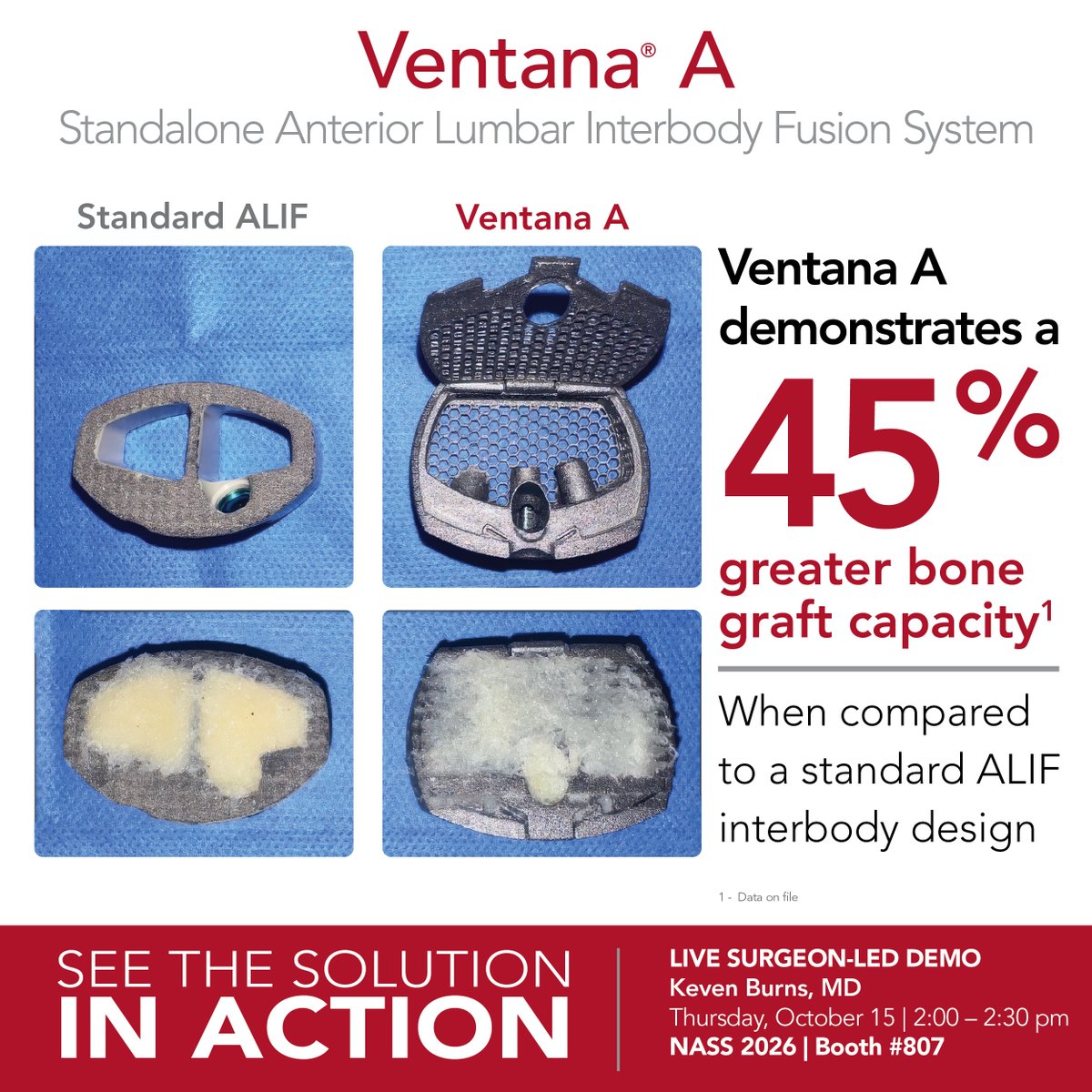 SpinalElements's tweet photo. Volume matters!
In a bench-top evaluation, Ventana A demonstrated 45% greater bone graft capacity compared to a standard ALIF interbody design.¹
And don’t miss our surgeon-led Ventana A demo with Keven Burns, MD:
Thursday, October 15 | 2:00–2:30 PM | Booth #807
 ¹ Data on file https://t.co/uGtzrZ6iLB
