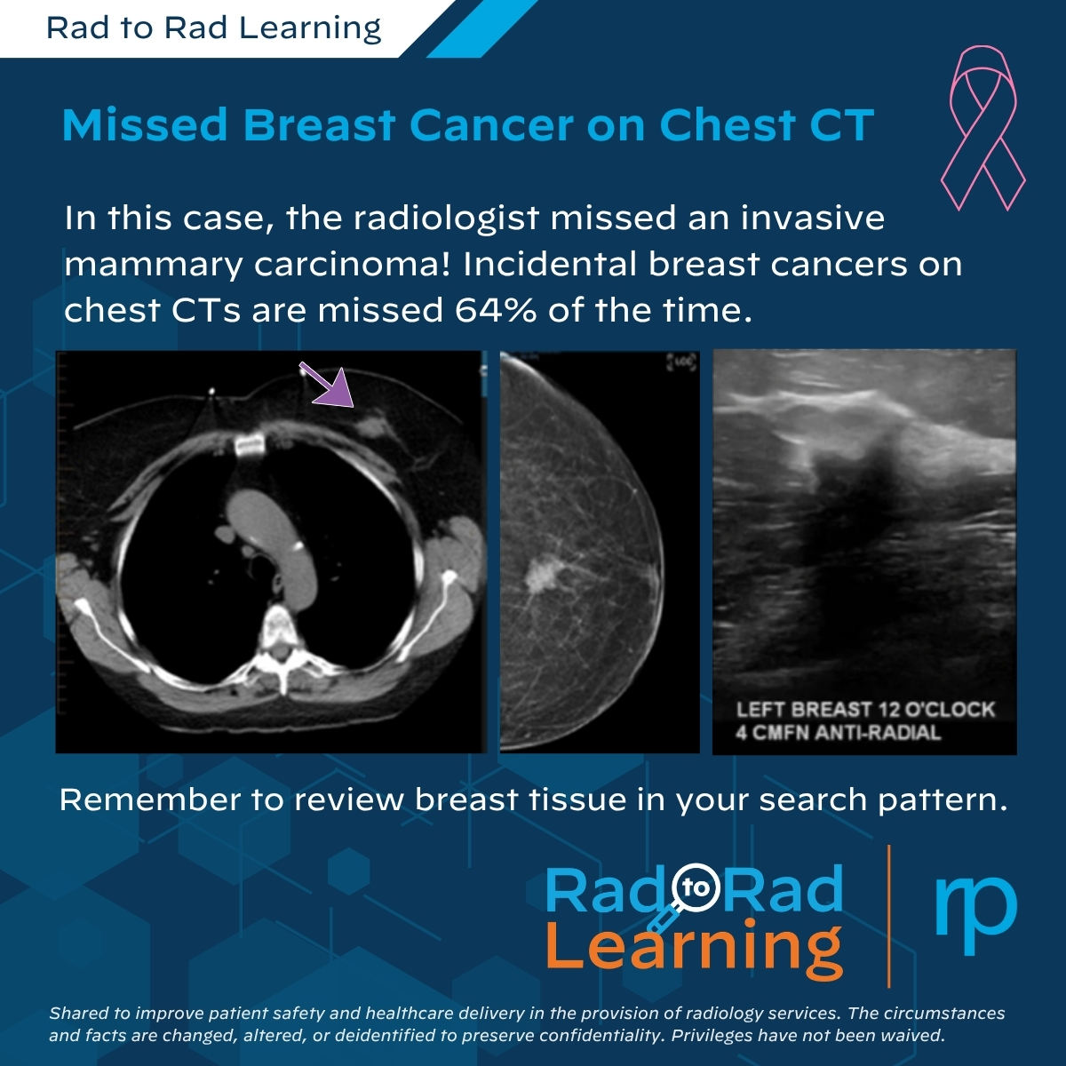 Rad_Partners's tweet photo. Throughout #BreastCancerAwarenessMonth, we’re sharing breast imaging cases from our Rad to Rad Learning series.

This week’s case highlights a breast cancer initially missed on a chest CT and the importance of including breast tissue in the search pattern.

Explore the case: https://t.co/PQwhlsbKjb