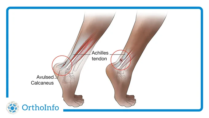 Side-by-side illustrations showing the different areas where an Achilles tendon tear can occur, at its attachment point on the calcaneus, and in the middle of the tendon.