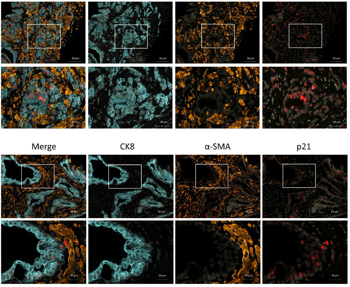 ExtracellMatrix's tweet photo. This work identified epithelial #senescence-associated signaling as a mechanism linking prostate epithelial alterations to fibroblast reprogramming and #ExtracellularMatrix remodeling. 

Check out the #OpenAccess paper. 👇 

https://t.co/3VNLdyYF8y https://t.co/eZzNP0InBX