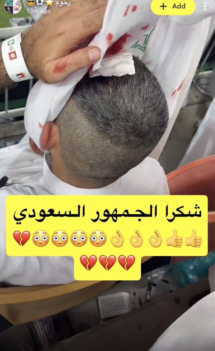433_uae2's tweet photo. 🚨🚨🚨🚨🚨🚨🚨🚨🚨🚨🚨🚨🚨🏥

إصابة أحد الجماهير الإماراتية ..

صورة توثق إصابة أحد الجماهير الإماراتية جراء رمي علب المياه باتجاه الجماهير الإماراتية 🇦🇪 في تصرف مؤسف من الجمهور السعودي 🇸🇦 بإتجاه جماهير الضيف 👎🏻!! https://t.co/dglQALok0O