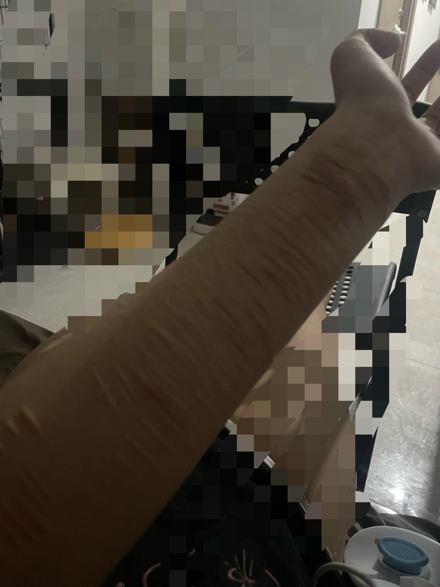 Ueerevr7's tweet photo. 恶心的手臂我不知道怎么面对所有人但是我还想割，只能在腿上别人看不到的地方，其他地方皮肤没适应好痛😭 https://t.co/AEIJBdp0KK