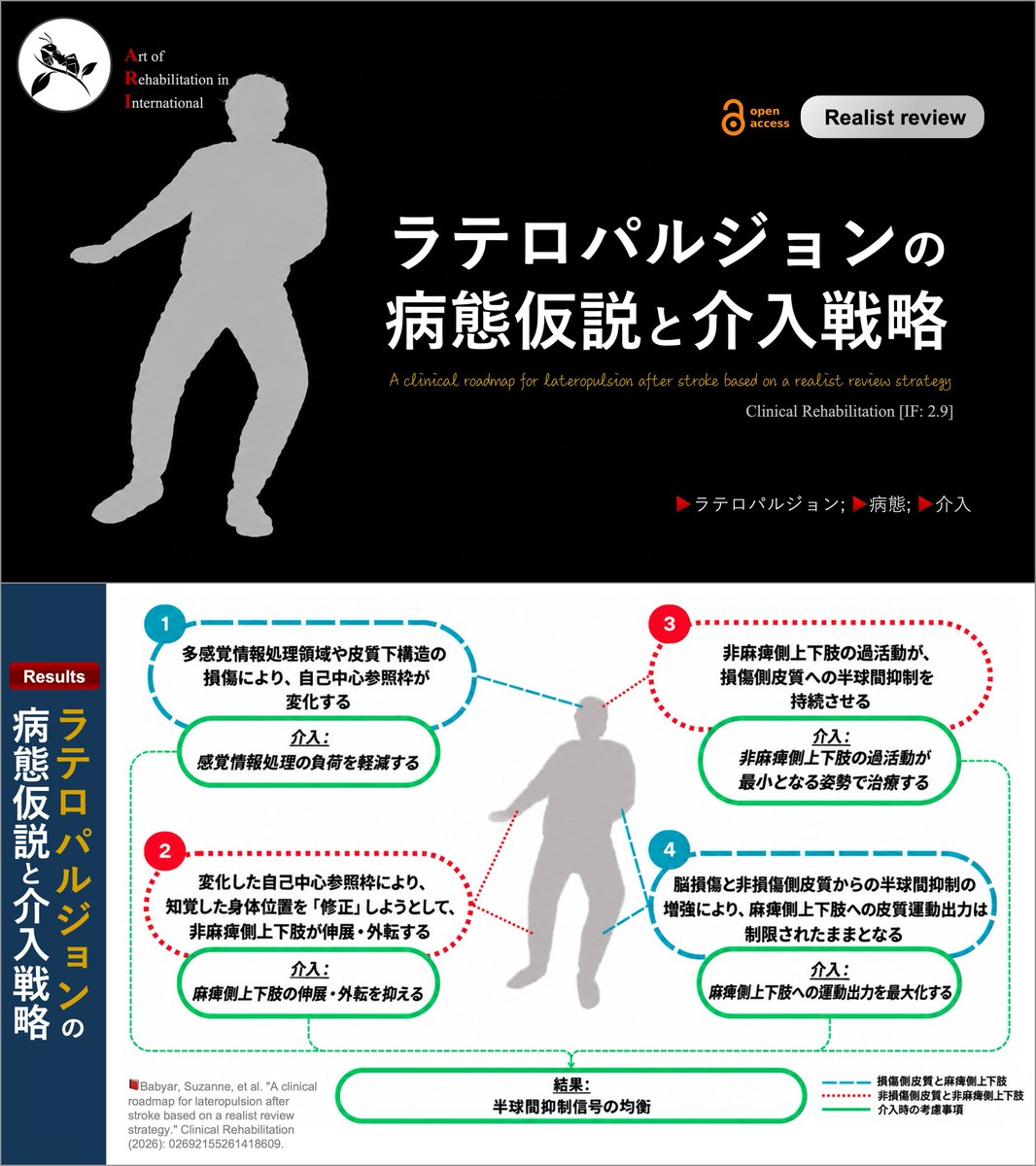copellist's tweet photo. 📕ラテロパルジョンの病態仮説と介入戦略
・レビュー → 病態仮説と介入戦略を構築

1️⃣感覚情報処理の異常
・病態仮説：多感覚情報の処理障害により、身体の「まっすぐ」の基準がずれる。
・介入戦略：感覚処理の負���を減らし、課題を単純化する。

2️⃣非麻痺側上下肢による「押し」
・病態仮説：身体のずれを修正しようとして、非麻痺側上下肢で麻痺側方向へ押す。
・介入戦略：非麻痺側上下肢による過剰な「押し」を抑える。

3️⃣非麻痺側の過活動
・病態仮説：非麻痺側の過活動により、損傷半球への半球間抑制が強まる。
・介入戦略：非麻痺側が過活動しにくい姿勢・課題で練習する。

4️⃣麻痺側への運動出力低下
・病態仮説：脳損傷と半球間抑制により、麻痺側への運動出力が低下する。
・介入戦略：麻痺側を積極的に使用し、運動出力を高める。

ラテロパルジョンに対する、
鍵穴（病態仮説）と鍵（介入戦略）が
セットで示されたレビュー論文です😲
#脳卒中 #ラテロパルジョン