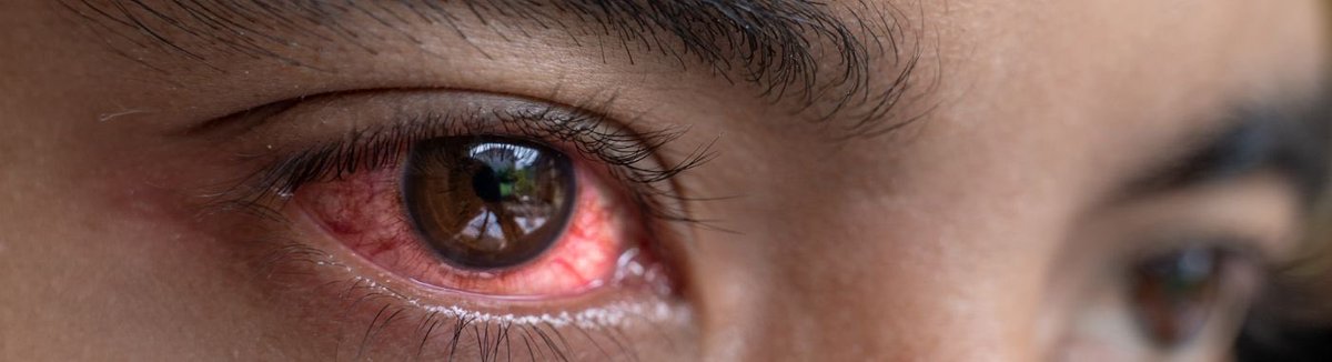 Prackg's tweet photo. Tengo enrojecidos los ojos, ¿alguien tendrá Kenal gotas que quiera compartir? Por favor. https://t.co/yRBPFv29Kj
