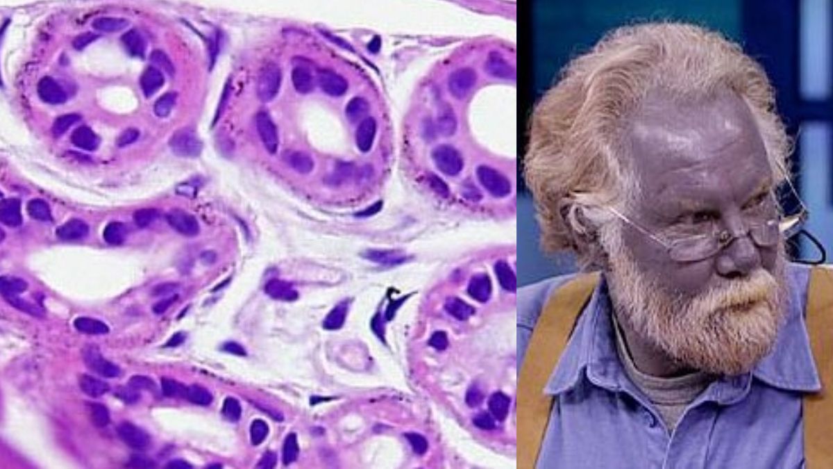 JMGardnerMD's tweet photo. What did he drink to turn his skin blue? 
Fancy name of this condition? 
Answers ✅ https://t.co/f6OWHD9kwv
#pathology #pathologists #pathTwitter #dermpath #dermatology #dermatologia #dermtwitter https://t.co/GEpo2gx9sU