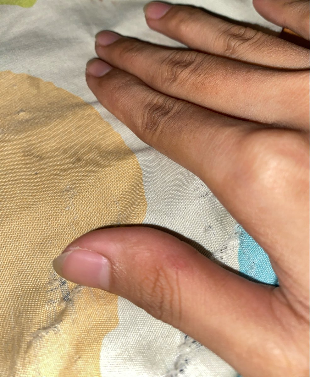 jp92523_'s tweet photo. Tangan udah full sakit bgt ini kena uapan setrikaan 🥲 https://t.co/XDqRPvfVbK