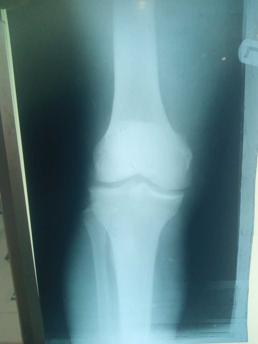 NathanAyuba2's tweet photo. @Vbonifacefan22 I wish you, @boniface_jrn, could help me with any amount to treat my knee injury 🤕 so I can continue chasing my football career.
Attached are my X-ray results.👇🏻
God bless you and help you continue to excel regardless. https://t.co/4rjSGoefwT