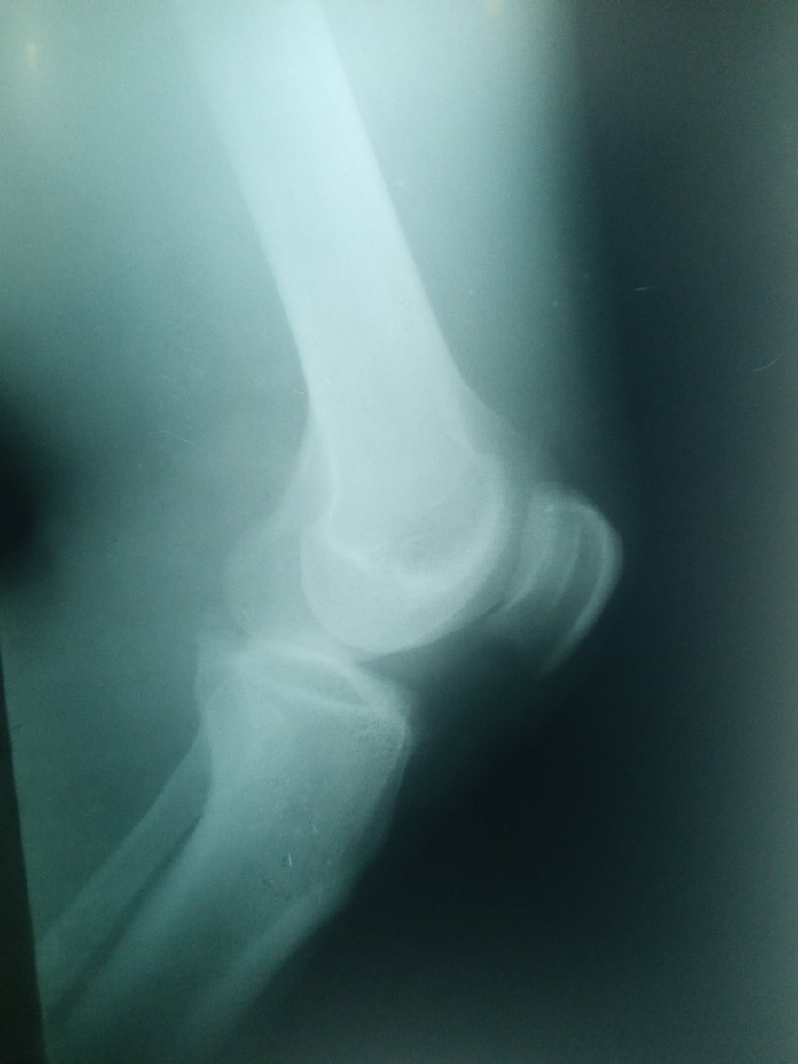 NathanAyuba2's tweet photo. @Vbonifacefan22 I wish you, @boniface_jrn, could help me with any amount to treat my knee injury 🤕 so I can continue chasing my football career.
Attached are my X-ray results.👇🏻
God bless you and help you continue to excel regardless. https://t.co/4rjSGoefwT