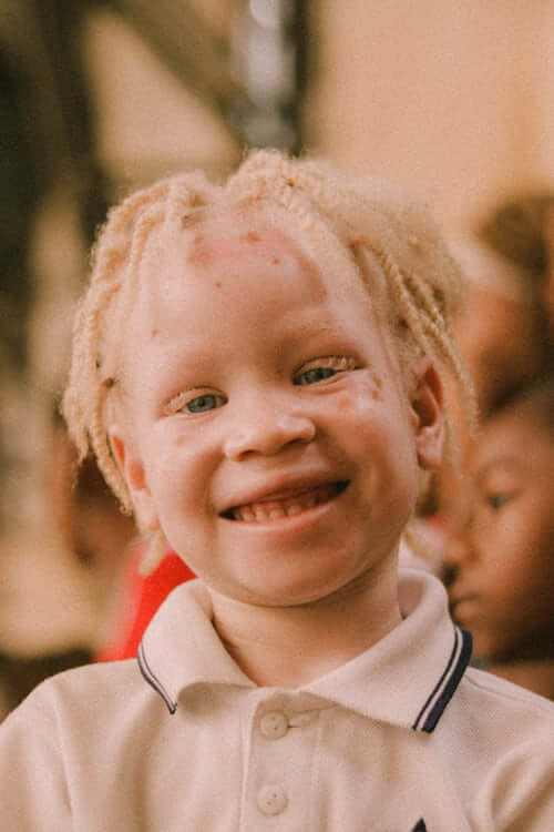 luvvybunnie's tweet photo. Do they think albinism takes away your ethnic features too orrrr https://t.co/Jb4gGjwJlT