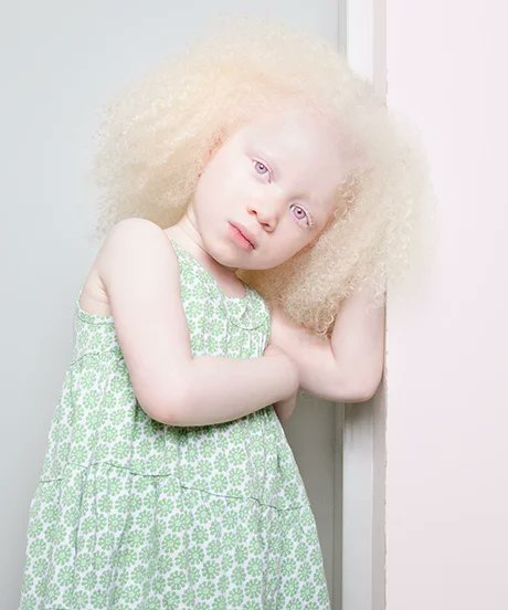 luvvybunnie's tweet photo. Do they think albinism takes away your ethnic features too orrrr https://t.co/Jb4gGjwJlT