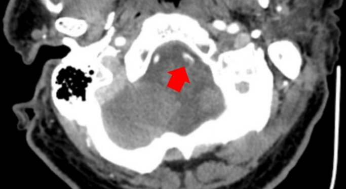 francisdeng's tweet photo. 63-year-old man presents with syncope.
ED: CTA head and neck
This finding in the intradural left vertebral artery is alleged to have been missed (real case image).
The malpractice complaint states the patient re-presented 9 hours later with distal embolization to the basilar artery (subocclusive) and left superior cerebellar artery (occlusive), resulting in permanent injury.