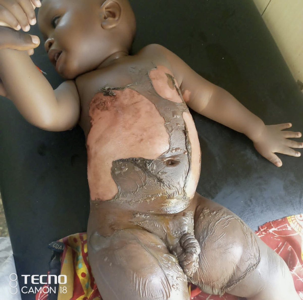 Deeey_man's tweet photo. Sorry to interrupt ur scrolling😩💔

My son was just accidentally got burnt by hot water and urgently need a medical treatment😭

He’s in critical condition and need a financial help to take him to hospital, i don’t have any kobo to save his life💔 

Acc No.
8030903651
Opay

🤲🏽🥹 https://t.co/yHYjGx0W2C