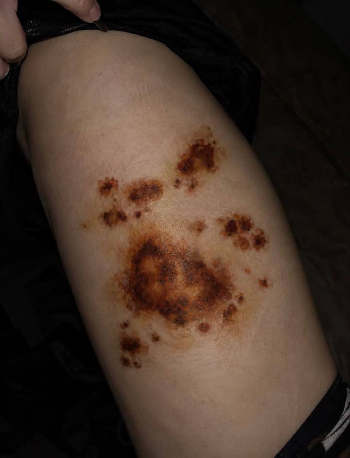 Carolus_XII_Rex's tweet photo. 🇷🇺Moscow: Gen Z are queuing for viral tattoos that make their skin look moldy, infected and literally rotting. https://t.co/XlpjnTxQPL
